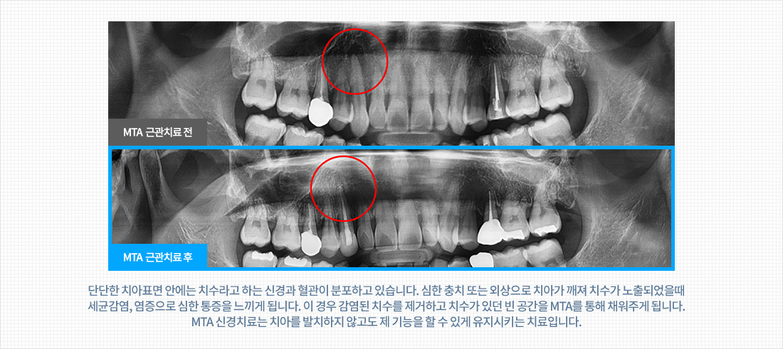 MTA 신경치료