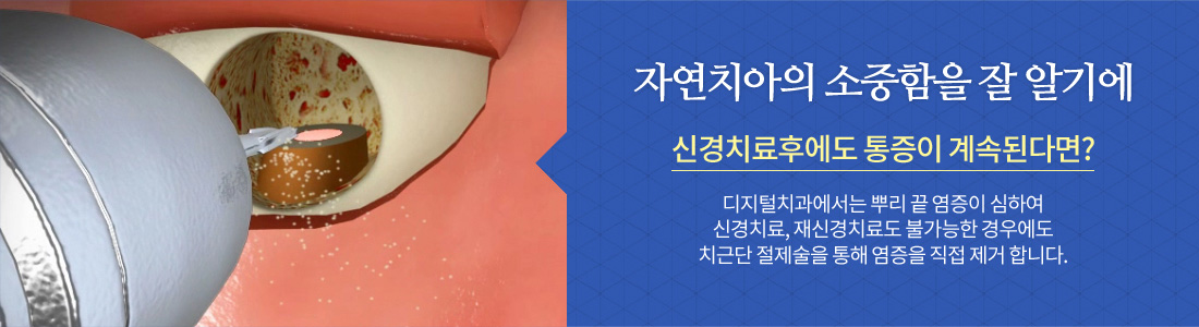 치근단 절제술