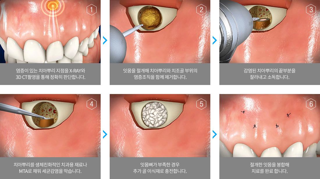 치근단 절제술