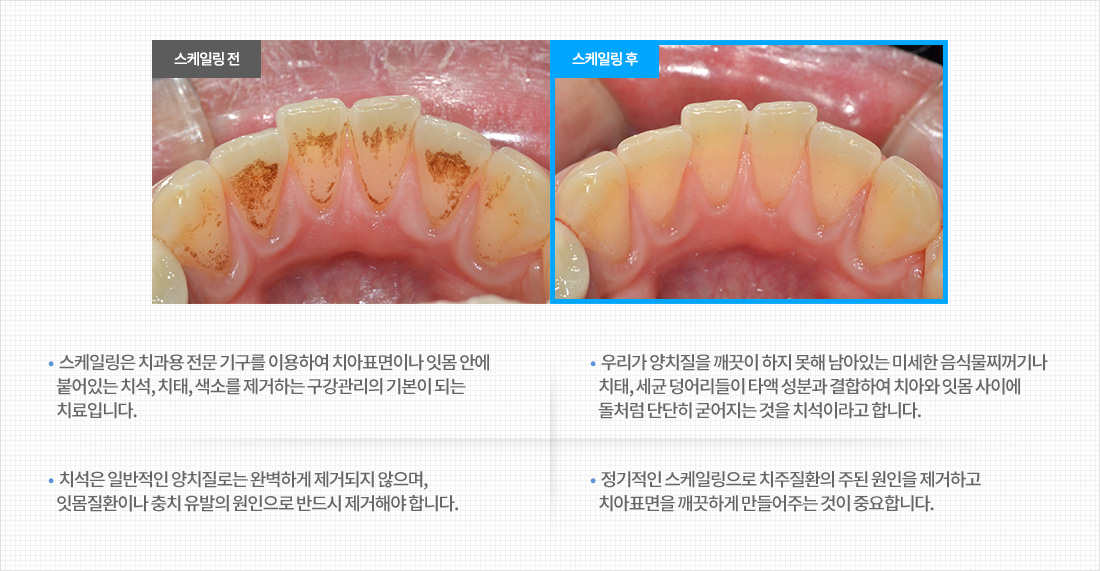 클린 스케일링