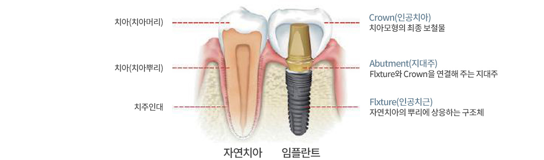 특별한 디지털 임플란트