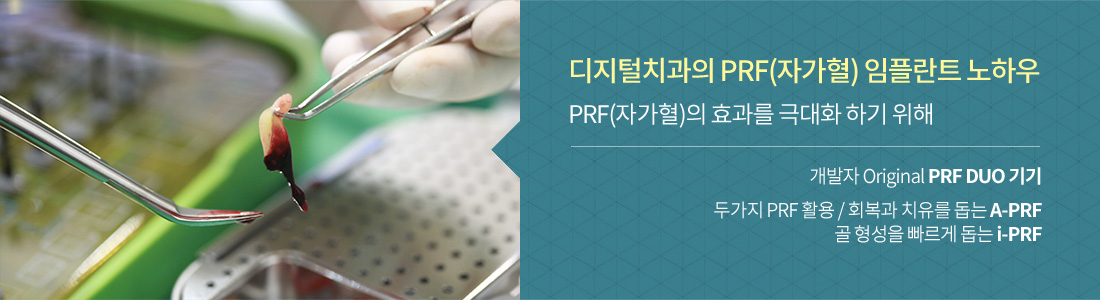 자가혈(PRF) 임플란트