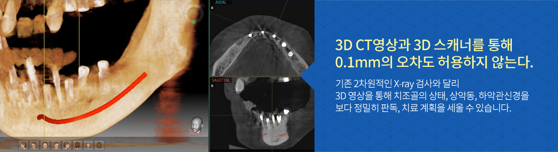 3D 맞춤 임플란트