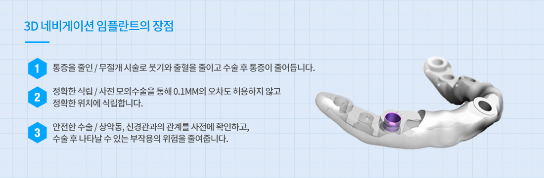 3D 맞춤 임플란트