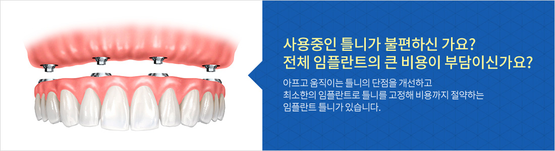 디지털 임플란트 틀니