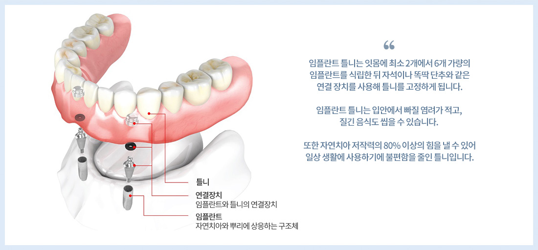 디지털 임플란트 틀니