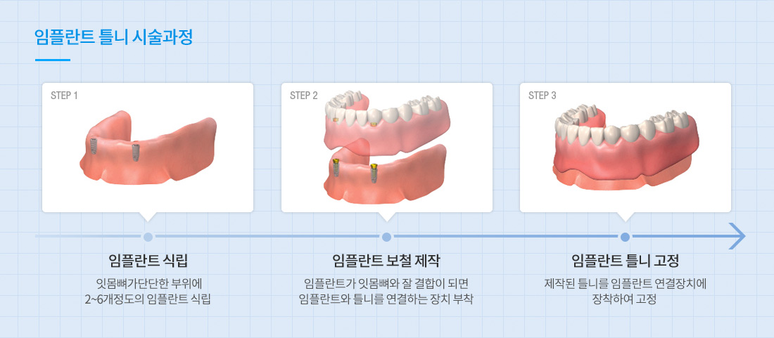 디지털 임플란트 틀니