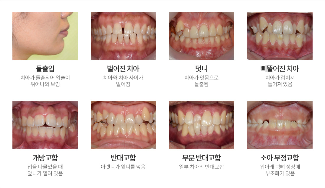 돌출입 : 치아가 돌출되어 입술이 튀어나와 보임 / 벌어진 치아 : 치아와 치아 사이가 벌어짐 / 덧니 : 치아가 잇몸으로 노출됨 / 삐뚤어진 치아 : 치아가 겹쳐쳐 틀어져 있음 / 개방교합 : 입을 다물었을 때 앞니가 열려 있음 / 반대교합 : 아랫니가 윗니를 덮음 / 부분 반대교합 : 일부 치아의 반대교합 / 소아 부정교합 : 위아래 턱뼈 성장에 부조화가 있음