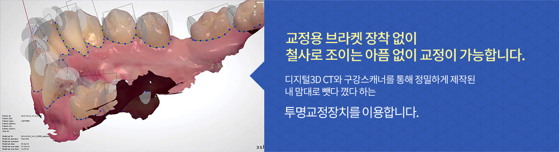 티안나는 투명교정