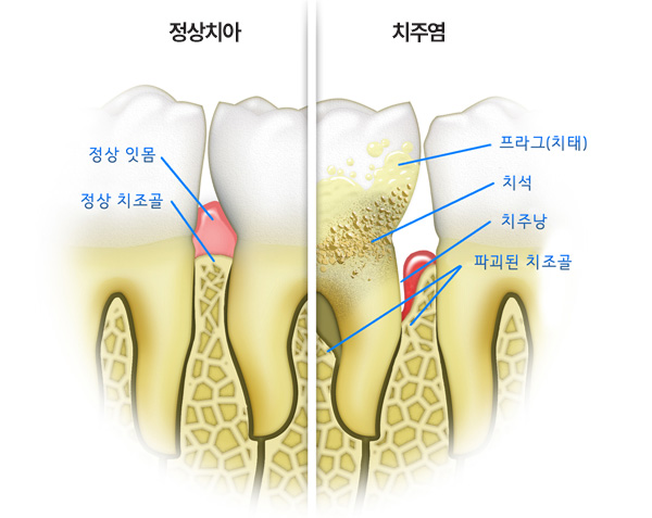 직장인 잇몸 관리