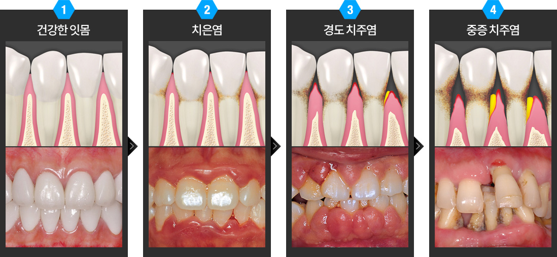 직장인 잇몸 관리