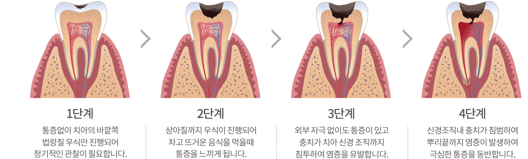 원데이 충치 치료