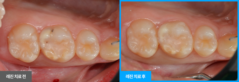 원데이 충치 치료