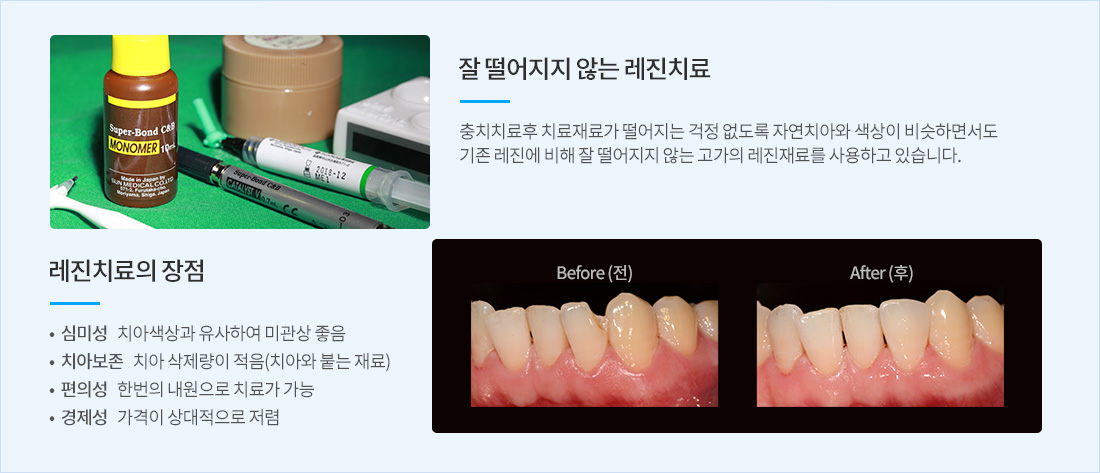 원데이 충치 치료