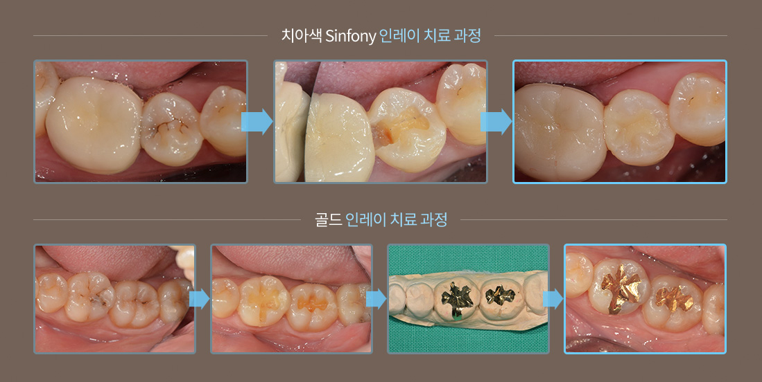 원데이 충치 치료