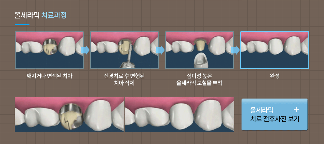 올세라믹