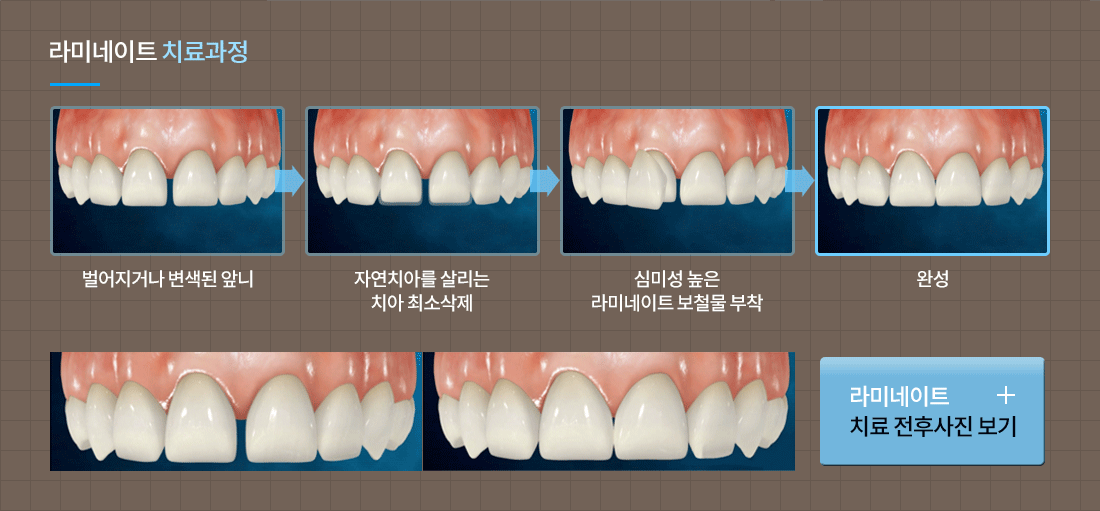 라미네이트/미백