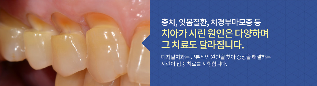 충치, 잇몸질환, 치경부마모증 등 치아가 시린 원인은 다양하며 그 치료도 달라집니다. 디지털치과는 근본적인 원인을 찾아 증상을 해결하는 시린이 집중 치료를 시행합니다.