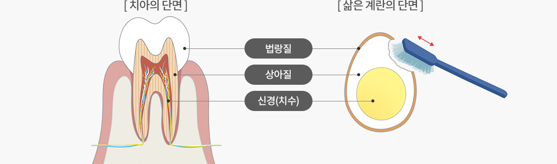 치아의 단면 / 삶은 계란의 단면(법랑질 > 상아질 > 신경(치수))