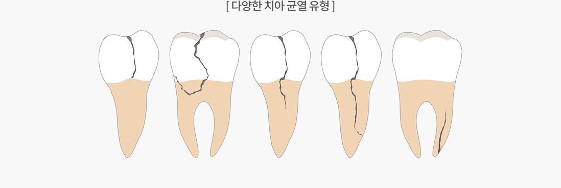 다양한 치아 균열 유형